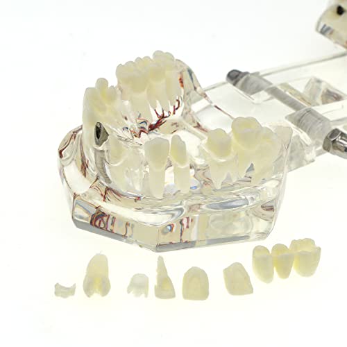 שיניים שתל תיקון עצבי פתולוגי שתל מחלה נשלף שיניים שקוף מחלת שיניים דגם עם שיניים שתל גשר, שיניים